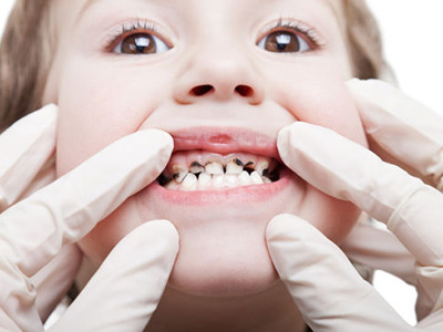 牙齒上小黑洞或會毀掉牙 定期口腔檢查很重要