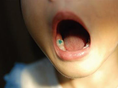 兒童可以提前預防蛀牙！家長你們知道嗎？