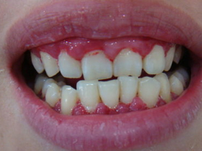口腔保健：預防齲齒4注意