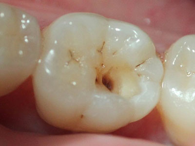 大牙中間有個洞是什麼原因