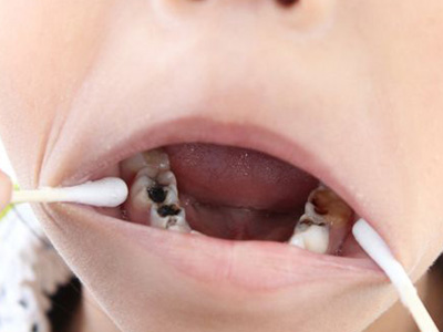 怎樣才知道自己有蛀牙？