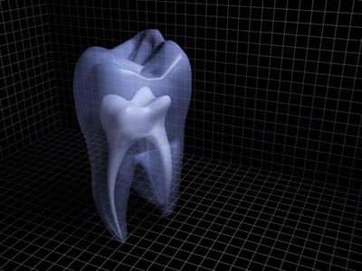 乳牙蛀牙會影響牙齒永久排列