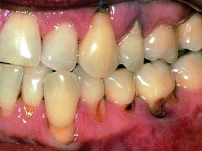 兒童長蛀牙到底需要治療麼？