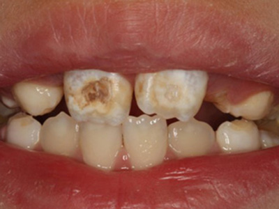 齲齒不及時補會誘發牙髓炎