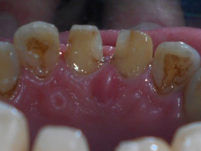 世界衛生組織稱：全球100%的成人有蛀牙
