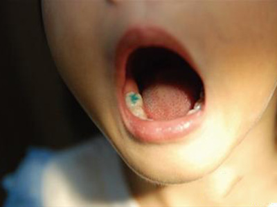 5歲以下兒童齲齒預防指南