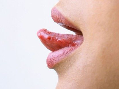 多數舌癌禍首是多年未處理的“爛牙”