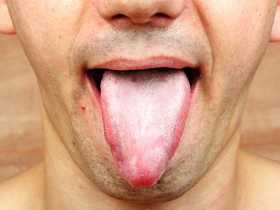 口腔不明出血警惕口腔癌 口腔癌怎麼簡單判斷？