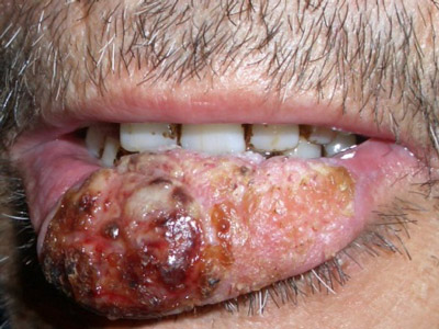 老漢嘴唇潰瘍2月沒好竟是唇癌 醫生：煙抽多了