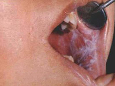 “口腔癌”的相關危險因素，有哪些？