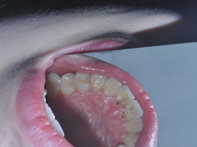 【口腔知識】兒童常見牙齒疾病症狀