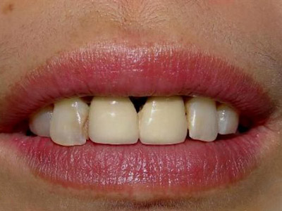牙周病變易口臭 經常塞牙應及時診治