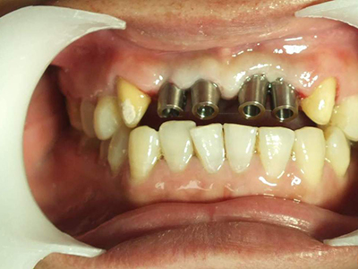 　牙模變形的原因及處理