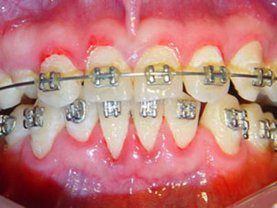 中國牙齒矯正患者為何60%要拔牙？