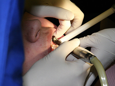 洗牙會造成牙齒松動、損傷嗎？