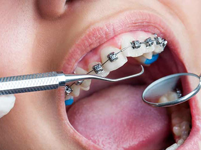 正牙會讓牙齒松動嗎？
