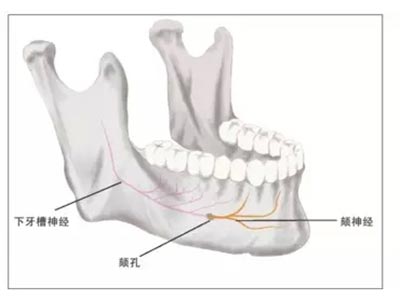 牙拔除術所致颏神經、頰神經及鼻腭神經損傷的預防與處理