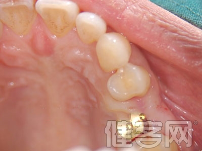 種植牙需要經過幾次手術治療才會正常