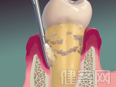 　　有很多人拔牙之後都遲遲不鑲牙，這樣危害很多。拔牙後如長時間不鑲牙，會給整個的口腔颌面系統帶來多方面的影響。