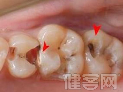 牙齒有小黑點是什麼原因