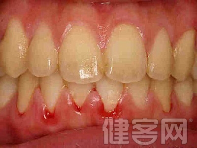 【科學防病】哪些疾病和行為可以引起牙齒形狀異常