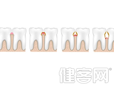 牙周炎：免疫細胞大殺四方的憂傷故事