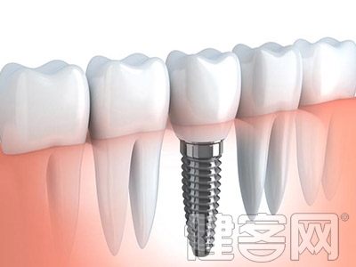 你嘴裡的<a name='InnerLinkKeyWord' href='http://www.jianke.com/news/928377.html' _fcksavedurl='http://www.jianke.com/news/928377.html' target='_blank'>種植牙</a>，真的了解麼？