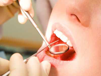 洗牙vs龈下刮治 到底啥區別？