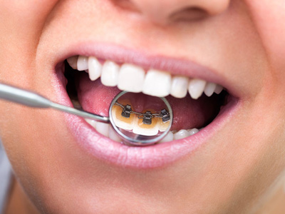 牙齒矯正十個誤區你中了幾條？