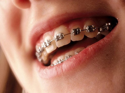 牙齒矯正十個誤區你中了幾條？