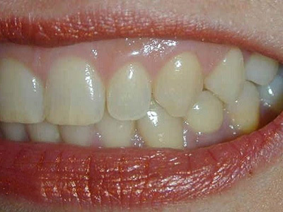 牙龈增生手術後多久才能牙齒矯正