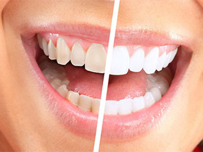 為什麼醫生總是說：定期洗牙