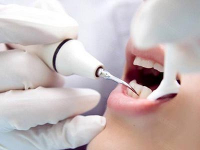 口腔科普知識：剖析不同洗牙的優缺點