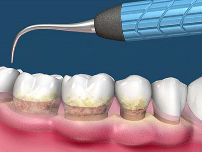 洗牙去牙結石的療效如何?