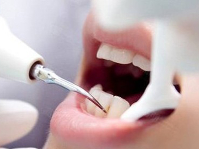 洗牙會讓牙齒“變薄”嗎？
