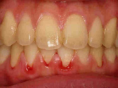 洗牙：跟牙菌斑的一期一會