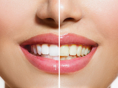 快來看你的牙齒距離“美白”還有多遠的路？