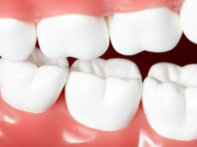 　瓷貼面美白牙齒效果如何？