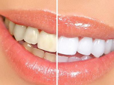 牙齒黃怎麼能讓牙齒變白呢