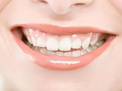 完美笑顏的秘密——冷光牙齒美白技術