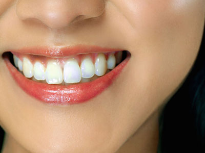 四環素牙的形成與美白方式