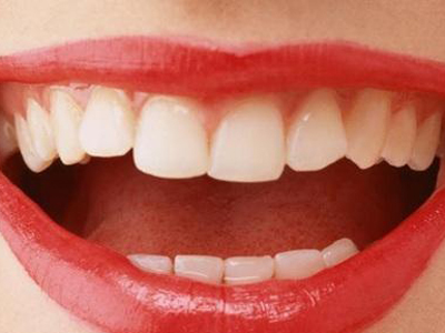 牙齒貼面的種類和特點比較