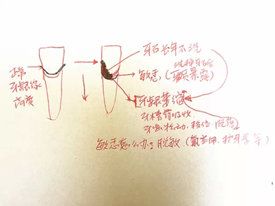 為什麼洗牙後牙齒會變得敏感？