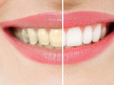 牙齒美白有什麼好的方法