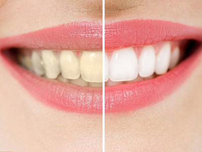 牙齒黃是咋回事？怎麼快速解決它？