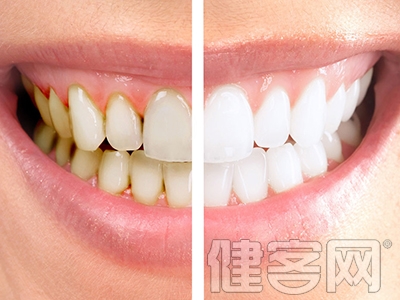 七種科學美白牙齒的方法
