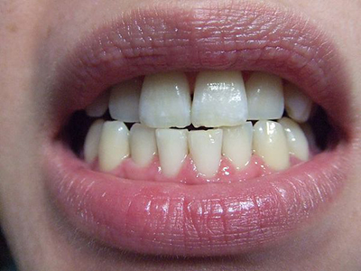 牙齒咬合異常的原因及預防