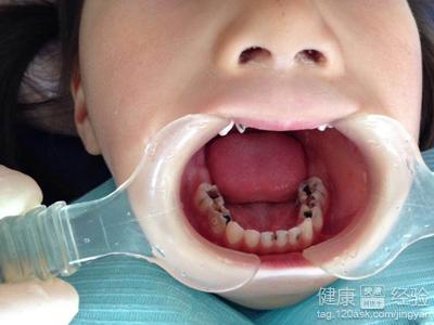 兒童齲齒怎麼治療?