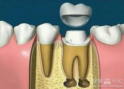 牙冠修復的步驟是什麼?有什麼步驟啊?