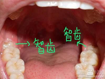 長智齒發炎灌膿，一定要拔掉嗎？